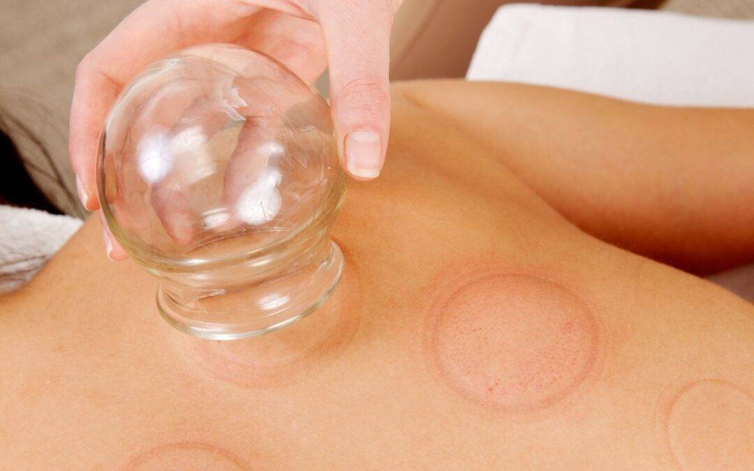 back detail of a young woman who just underwent an acupuncture fire cupping treatment