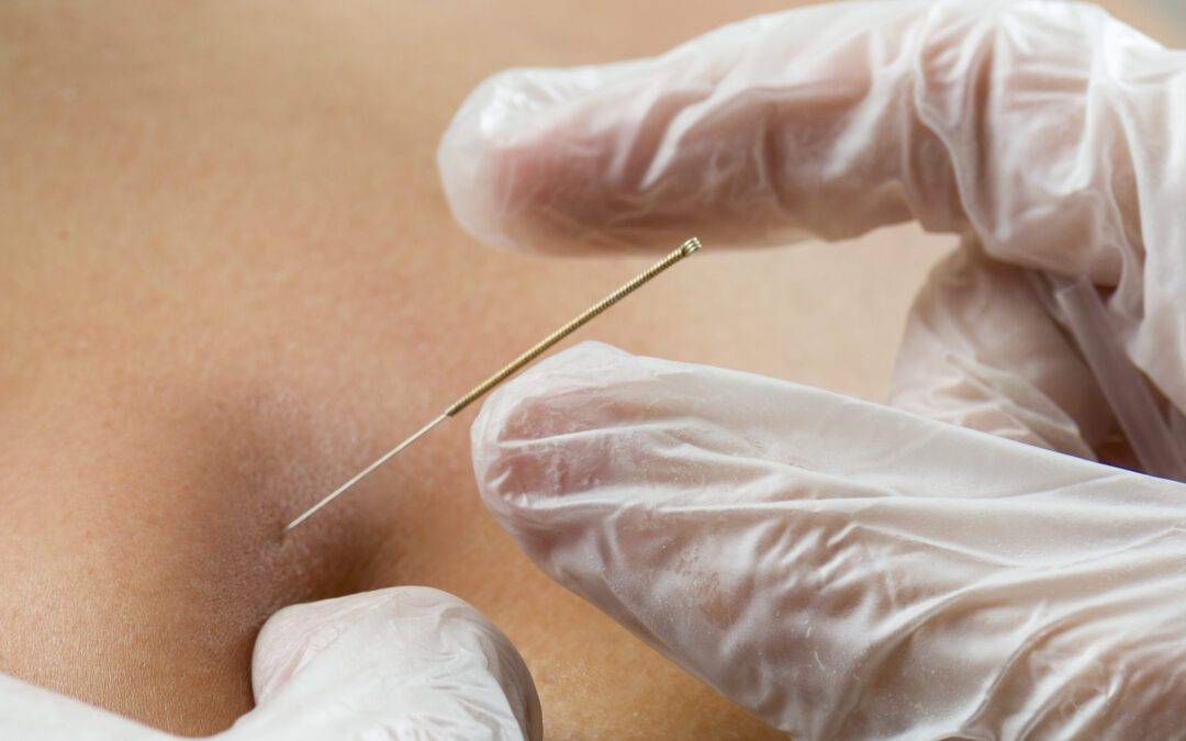 Closeup of a needle and hands of physiotherapist doing a dry needling.