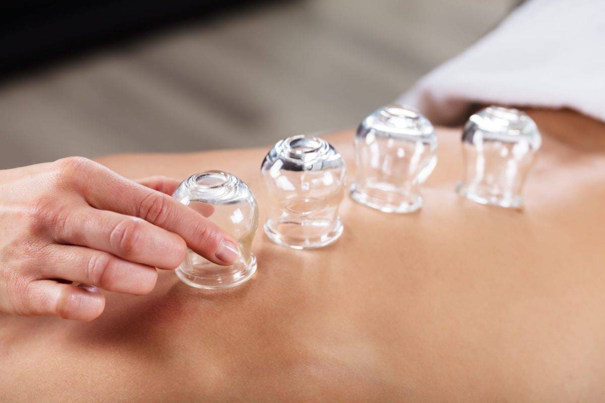 Therapist Placing Cups On Person's Back