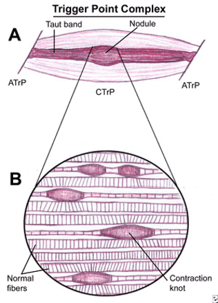 Trigger point Complex